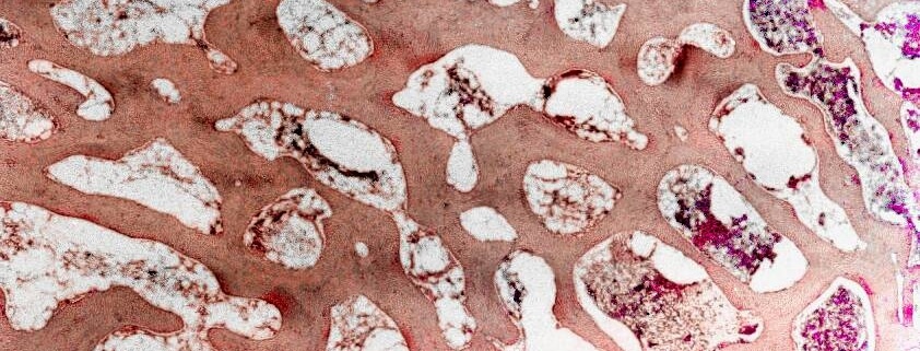 ΟΣΤΕΟΜΥΕΛΙΚΗ ΒΙΟΨΙΑ